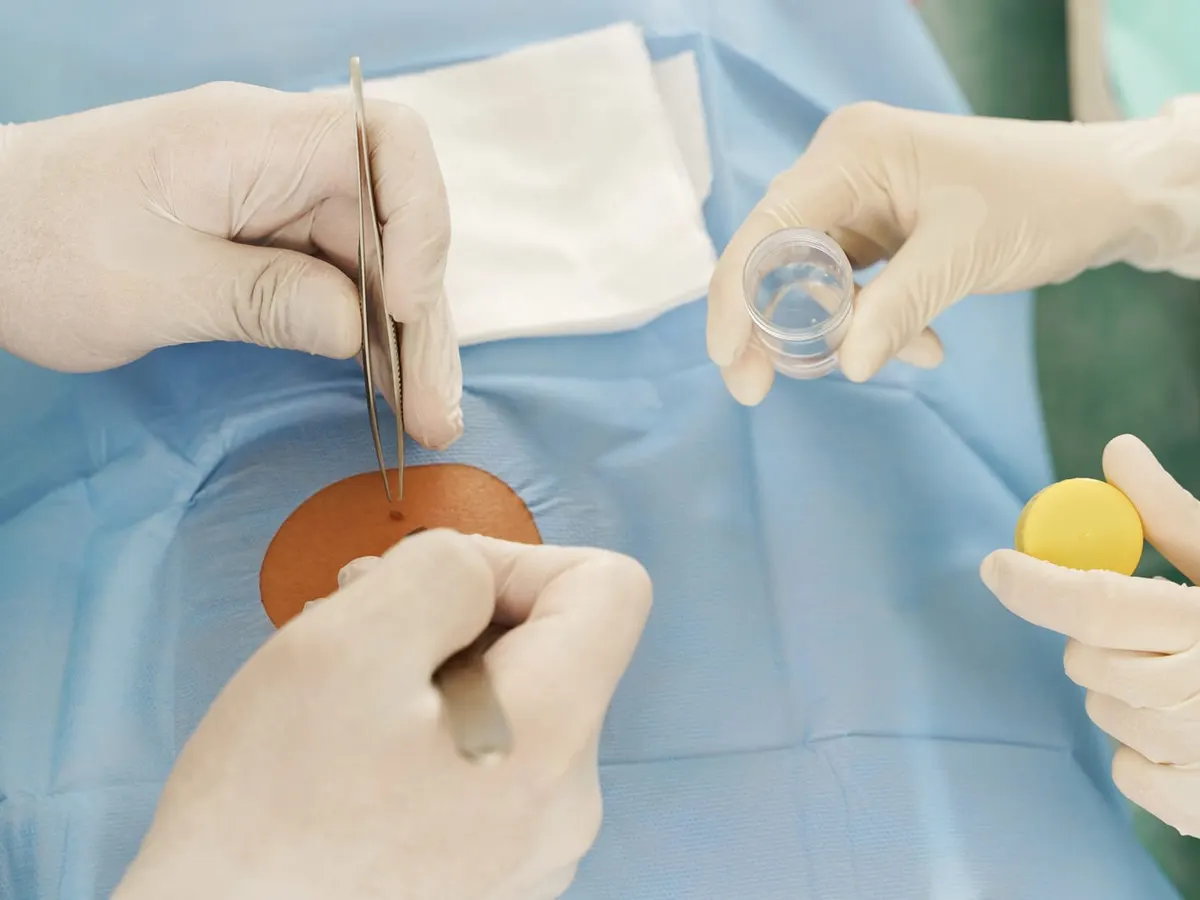 Stock photograph of models: gloved hands of a surgeon and an assistant remove a small growth from a patient’s skin through a surgical drape