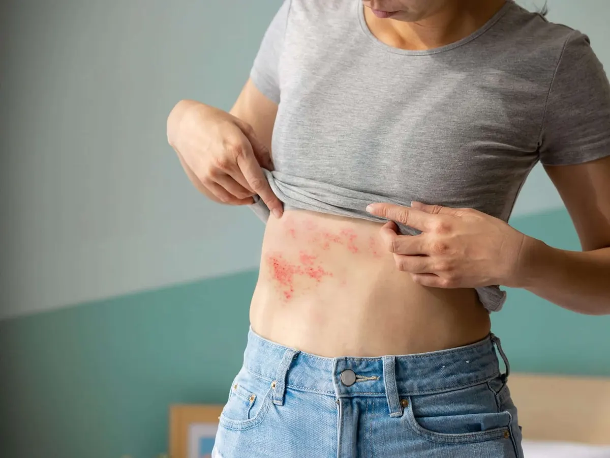 Stock photograph of a model: close up of a woman suffering from shingles on her abdomen