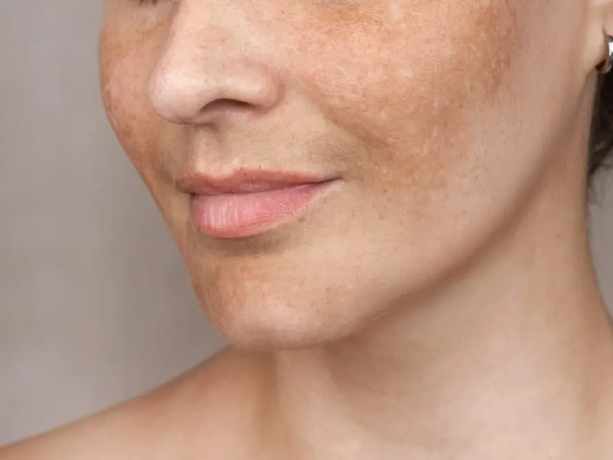 Stock photograph of a model: close-up of a woman's lower face with freckles and uneven brown pigmentation