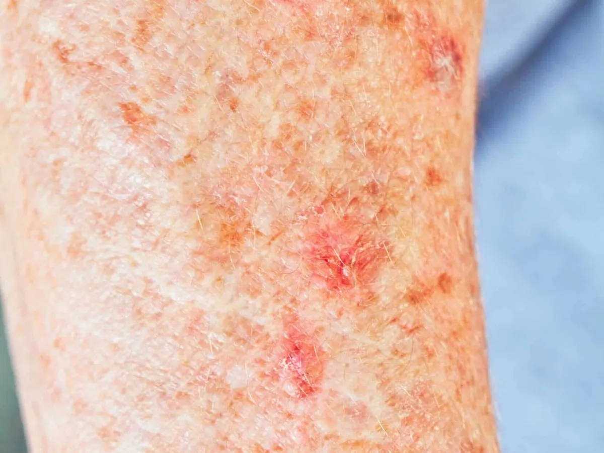 Stock photograph of a model: close-up of sun-damaged skin on an arm with rough red patches and brown spots related to actinic keratosis