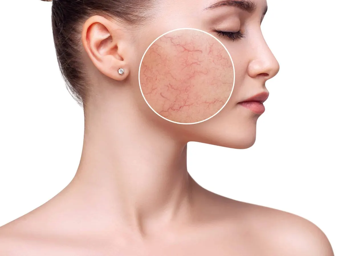 Stock photograph of a model: a woman in profile with a circular magnified inset showing redness and fine blood vessels on her cheek