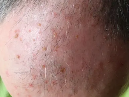 Stock photograph of a model: close-up of a man's thinning scalp with rough, red, scaly spots
