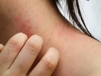 Stock photograph of a model: a woman scratches a red rash on the side of her neck