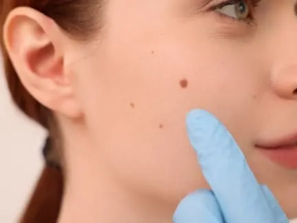 Stock photograph of a model: a woman in profile with a mole on her cheek, a gloved finger beside it