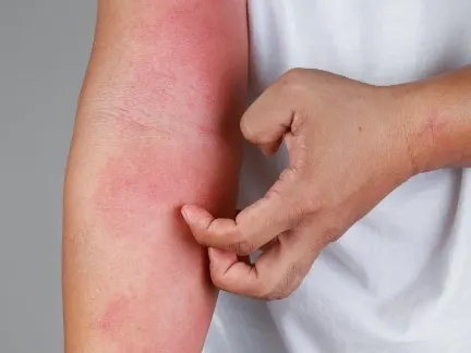 Stock photograph of a model: a person scratches red, scaly patches of skin on the forearm