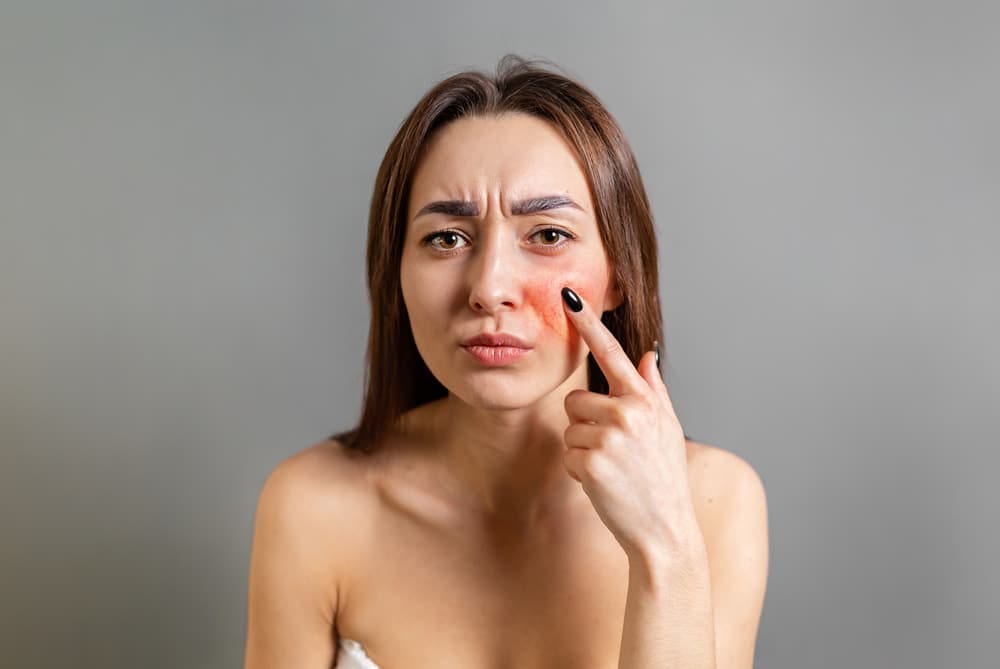 Stock photograph of a model: a woman with rosacea looking at her cheeks