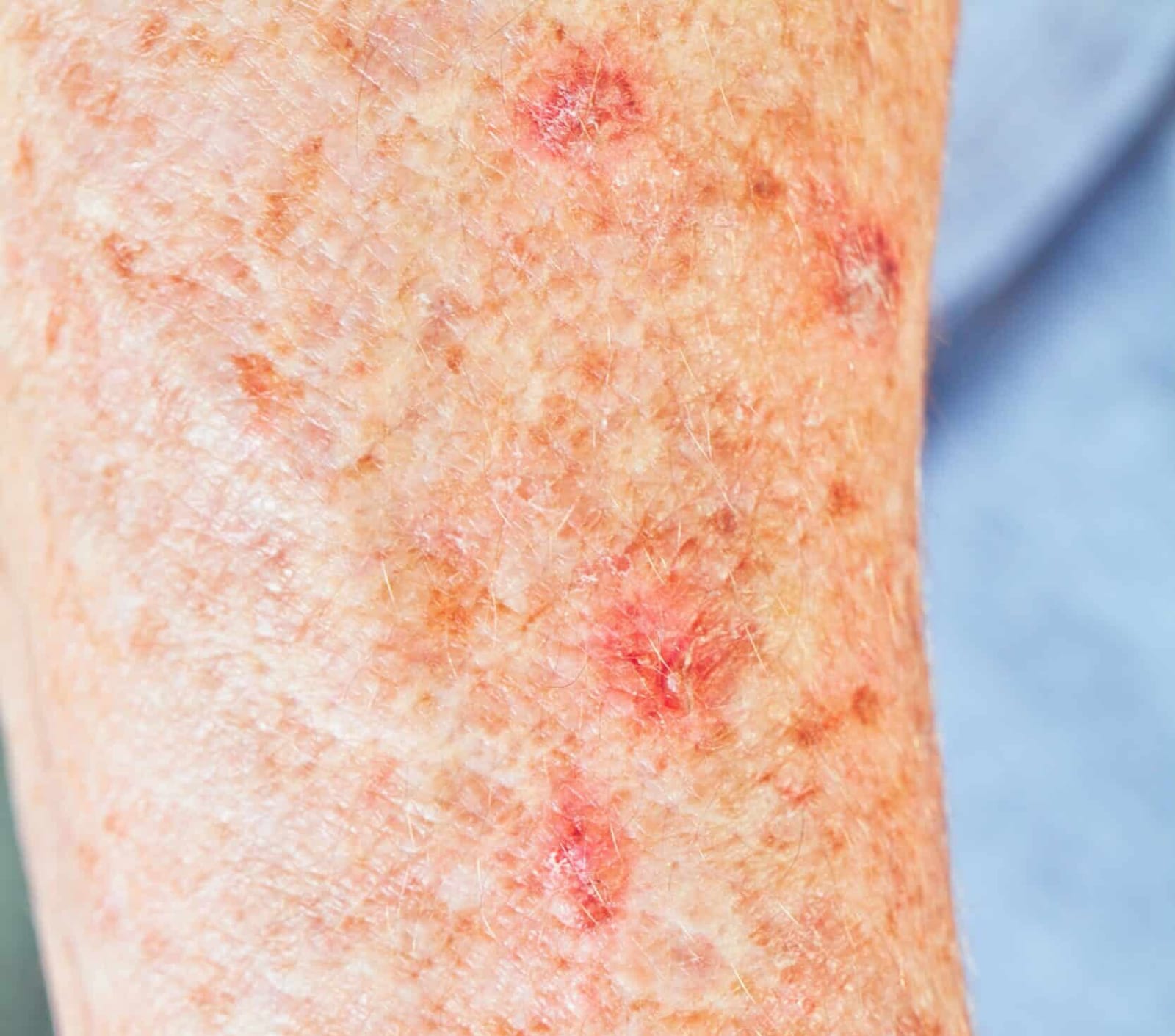 Stock photograph of a model: close-up of sun-damaged skin on an arm with rough red patches and brown spots related to actinic keratosis