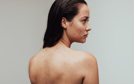 Stock photograph of a model: a woman with acne on her cheek and back looks over her bare shoulder