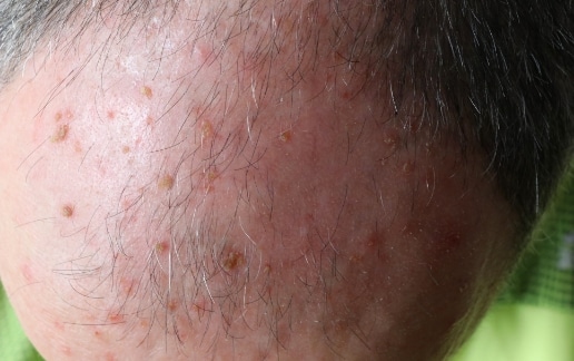 Stock photograph of a model: close-up of a man's thinning scalp with rough, red, scaly spots