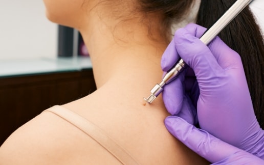 Stock photograph of models: a gloved clinician touches an instrument to a small growth on a woman's neck