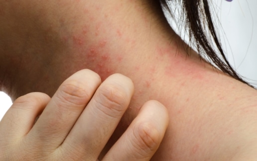 Stock photograph of a model: a woman scratches a red rash on the side of her neck