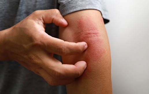 Stock photograph of a model: a man scratches a red, inflamed patch of skin on his arm