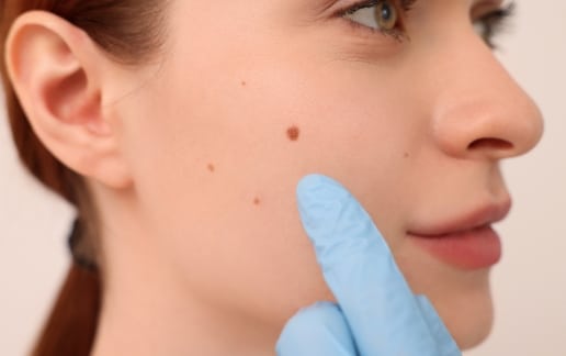 Stock photograph of a model: a woman in profile with a mole on her cheek, a gloved finger beside it