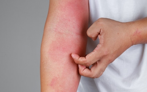 Stock photograph of a model: a person scratches red, scaly patches of skin on the forearm