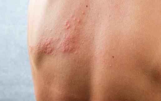 Stock photograph of a model: raised red bumps of a rash across a person's upper back