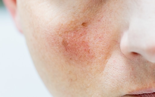 Stock photograph of a model: close-up of redness and small visible blood vessels on a cheek beside the nose