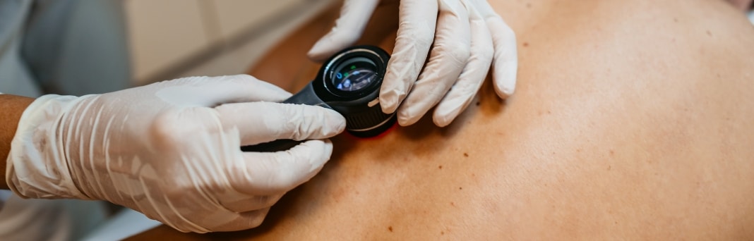 Stock photograph of models: a gloved clinician holds a dermatoscope against a patient's skin
