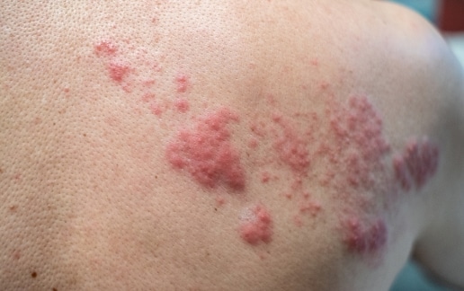 Stock photograph of a model: clusters of a red, blistering rash on a person's skin