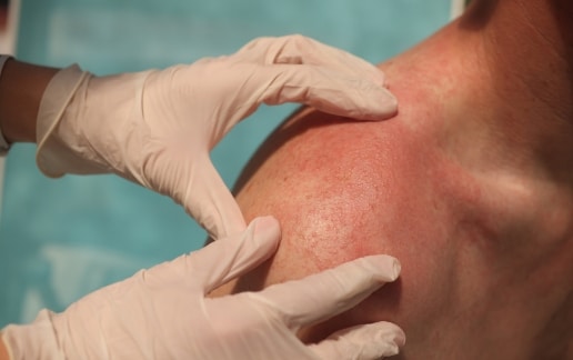 Stock photograph of models: gloved hands examine red, sun-damaged skin on a man's shoulder