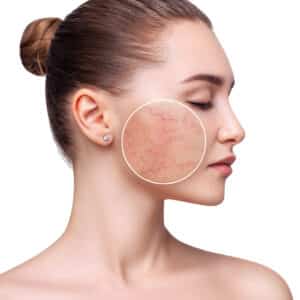 Close-up of a woman with rosacea on her cheeks, highlighting redness and irritation, in Spicewood, Texas