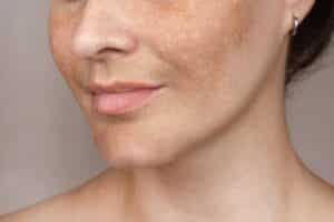 Close-up of a Caucasian woman's face showing freckles and age spots, highlighting the effects of photoaging and sun damage.