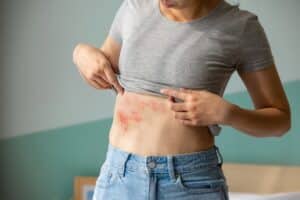 Close up of a woman suffering from shingles on her abdomen