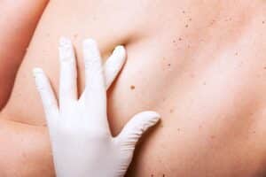Spicewood, TX dermatologist performing a skin cancer screening for melanoma