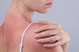 Woman with a sunburn seeking sun damage treatment in Spicewood, TX