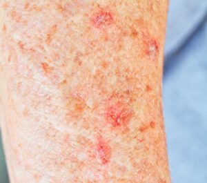Skin cancer screening exam being performed by a dermatologist in Spicewood Close-up of sun-damaged skin on an arm with rough red patches and brown spots related to actinic keratosis.